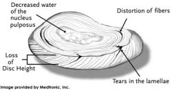 disc-injury
